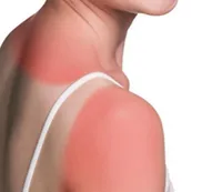 Sunburnt skin on a woman's shoulder.